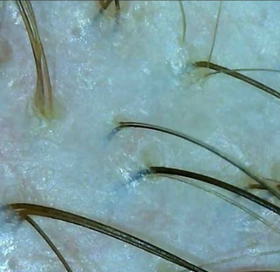 Результат трихоскопії - реальна оцінка стану шкіри голови та полотна волосся